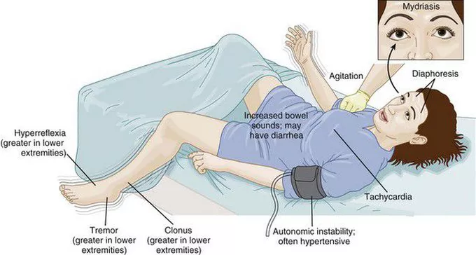 Neuroleptic Malignant Syndrome