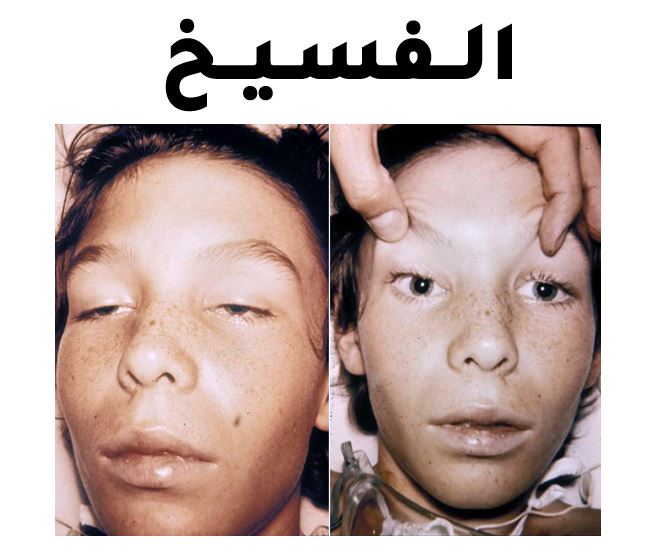 Botulism Protocol - الفسيخ